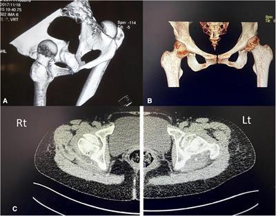 Surgical treatment and functional outcome of bilateral symmetrical hip dislocation and Pipkin type II femoral head fracture: a 5-year follow-up case report and literature review